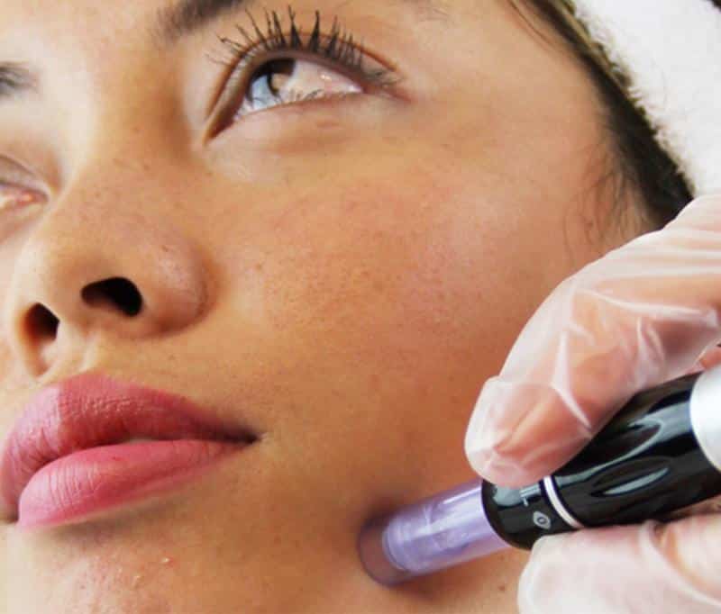 microneedling behandeling
