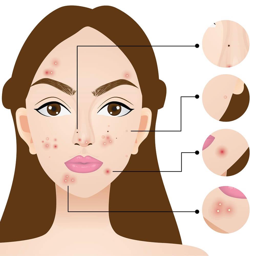 acne-types
