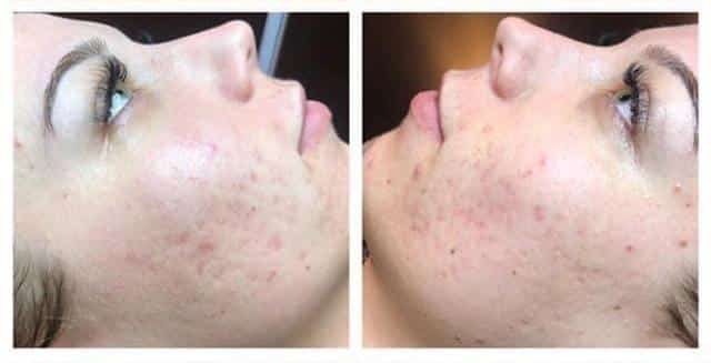 acne littekens behandelen in Den Haag